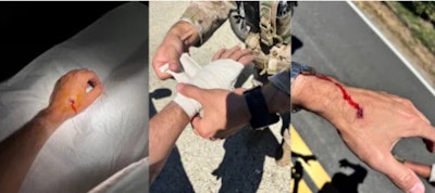 Ice Hand Wound